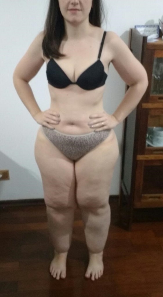 O estudo revelou que 94% das pacientes ouvidas relataram limitação física e impacto psicossocial devido à doença, um tumor de gordura, que provoca dor e deixa mulheres com pernas e braços grossos desproporcionais, e joelhos sem contorno. Foto: divulgação 