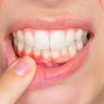 Recelebrando o Dia Mundial do Combate ao diabetes (14 de novembro), especialistas alertam para essa patologia que afeta 1 em cada 11 pessoas no mundo todo e que está ligada diretamente a saúde bucal e merece atenção. Imagem: relacionada