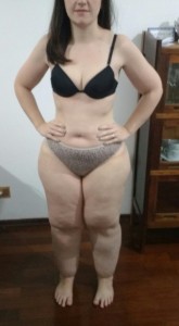 O estudo revelou que 94% das pacientes ouvidas relataram limitação física e impacto psicossocial devido à doença, um tumor de gordura, que provoca dor e deixa mulheres com pernas e braços grossos desproporcionais, e joelhos sem contorno. Foto: divulgação