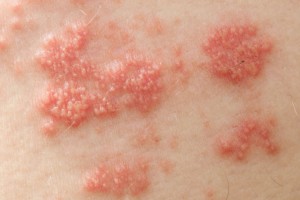 Ao longo da vida, cerca de 20% das pessoas contaminadas previamente pelo vírus podem desenvolver o herpes-zóster e causar lesões na córnea. Crédito: Getty Images/iStockphoto