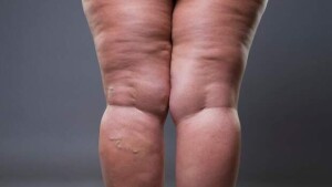 Os sintomas da doença incluem pernas pesadas e dolorosas, sensibilidade ao toque, tendência a hematomas e inchaço crônico. (Foto: Depositphotos)