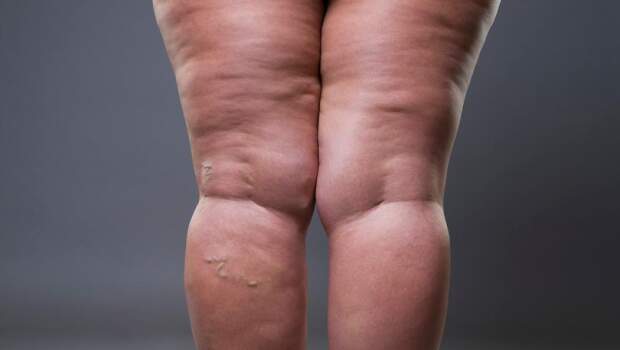 Os sintomas da doença incluem pernas pesadas e dolorosas, sensibilidade ao toque, tendência a hematomas e inchaço crônico. (Foto: Depositphotos)