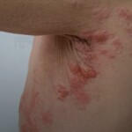 Também conhecido como "cobreiro", Herpes Zoster é uma condição dolorosa que pode afetar a qualidade de vida das pessoas, especialmente dos idosos e daqueles com o sistema imunológico comprometido. (Divulgação)
