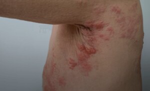 Também conhecido como "cobreiro", Herpes Zoster é uma condição dolorosa que pode afetar a qualidade de vida das pessoas, especialmente dos idosos e daqueles com o sistema imunológico comprometido. (Divulgação)