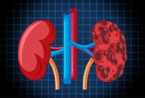 O urologista Dr. Ivan Selegatto destaca a importância da prevenção e do diagnóstico precoce e alerta para fatores de risco como: tabagismo, obesidade e hipertensão aumentam a probabilidade de desenvolvimento da doença. (Reprodução / Google
