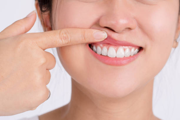 A causa do abscesso periodontal pode ser da presença permanente de placa e tártaro em bolsas periodontais. (Istockphoto /divulgação