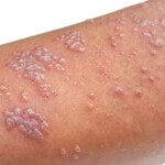 Neurocirurgião da Unicamp comenta achados promissores para a prevenção das condições e reforça a importância da cautela diante de dados ainda preliminares. (herpes zoster / reprodução Google)