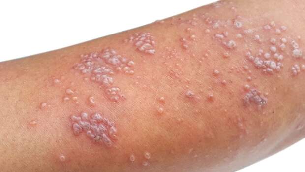 Neurocirurgião da Unicamp comenta achados promissores para a prevenção das condições e reforça a importância da cautela diante de dados ainda preliminares. (herpes zoster / reprodução Google)