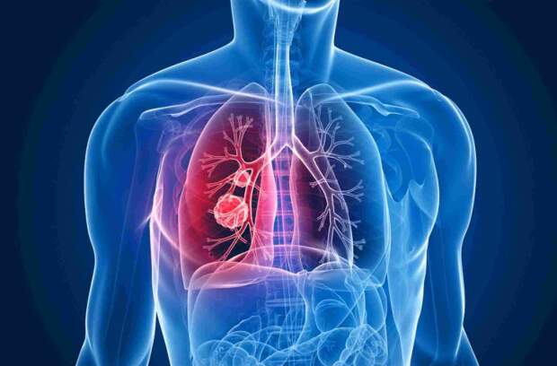 Na somatória dos nove estados do Nordeste, a projeção é que entre 1.314 e 1642 pessoas, que nunca fumaram, recebam o diagnóstico de câncer de pulmão este ano. (imagem: reprodução /medicinasa) 