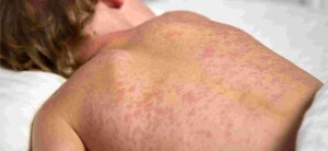 “O sarampo é uma das doenças mais contagiosas que existem. Uma única pessoa infectada pode transmitir o vírus para mais de 90% das pessoas suscetíveis próximas”, alerta infectologista. A melhor forma de controle ainda é a vacinação. (Divulgação / Portal gov.br).