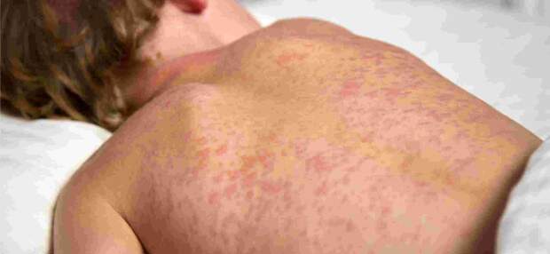 “O sarampo é uma das doenças mais contagiosas que existem. Uma única pessoa infectada pode transmitir o vírus para mais de 90% das pessoas suscetíveis próximas”, alerta infectologista. A melhor forma de controle ainda é a vacinação. (Divulgação / Portal gov.br).