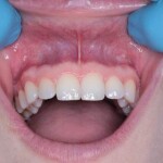 (Disbiose_oral - Portal Afya - reprodução)