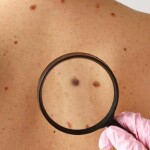 A Sociedade Brasileira de Cirurgia Oncológica (SBCO) reforça a importância da prevenção e do diagnóstico precoce do câncer de pele. A adoção de hábitos de proteção diária, o reconhecimento dos sinais de alerta e o acesso ao tratamento adequado podem evitar casos avançados, com menos danos e maior chance de cura. (Divulgação).