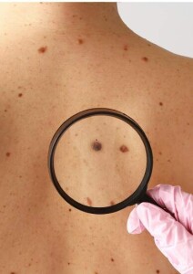 A Sociedade Brasileira de Cirurgia Oncológica (SBCO) reforça a importância da prevenção e do diagnóstico precoce do câncer de pele. A adoção de hábitos de proteção diária, o reconhecimento dos sinais de alerta e o acesso ao tratamento adequado podem evitar casos avançados, com menos danos e maior chance de cura. (Divulgação).