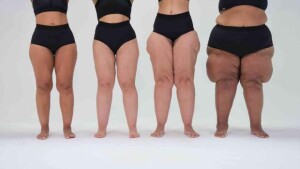 Subdiagnosticada, doença leva milhões de mulheres a anos de tratamentos ineficazes, gastos recorrentes e impacto profundo na qualidade de vida. (foto: Mulheres com diversos graus de lipedema / divulgação @ongmovimentolipedema)