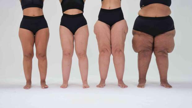 Subdiagnosticada, doença leva milhões de mulheres a anos de tratamentos ineficazes, gastos recorrentes e impacto profundo na qualidade de vida. (foto: Mulheres com diversos graus de lipedema / divulgação @ongmovimentolipedema)