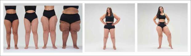 Mulheres com diversos graus de lipedema - crédito fotos: divulgação @ongmovimentolipedema