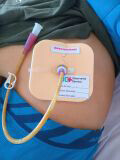 JO+ Absorvente Dérmico, tecnologia para paciente gastrostomizado. (Divulgação)