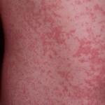 Com previsão de temperaturas elevadas e chuvas irregulares no Nordeste, especialistas orientam manter os cuidados contra o Aedes aegypti, vetor da doença, dentro e fora de casa. (Zika Virus / reprodução)