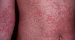 Com previsão de temperaturas elevadas e chuvas irregulares no Nordeste, especialistas orientam manter os cuidados contra o Aedes aegypti, vetor da doença, dentro e fora de casa. (Zika Virus / reprodução)