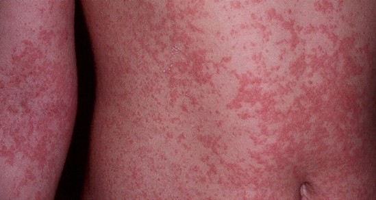Com previsão de temperaturas elevadas e chuvas irregulares no Nordeste, especialistas orientam manter os cuidados contra o Aedes aegypti, vetor da doença, dentro e fora de casa. (Zika Virus / reprodução)